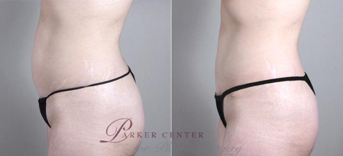Mommy Makeover Case 383 Before & After View #4 | Paramus, NJ | Parker Center for Plastic Surgery