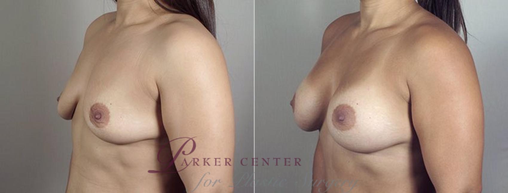 Mommy Makeover Case 406 Before & After View #2 | Paramus, NJ | Parker Center for Plastic Surgery