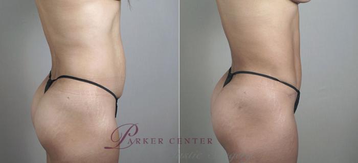 Mommy Makeover Case 406 Before & After View #4 | Paramus, NJ | Parker Center for Plastic Surgery