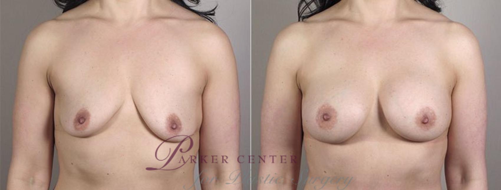 Mommy Makeover Case 407 Before & After View #1 | Paramus, NJ | Parker Center for Plastic Surgery