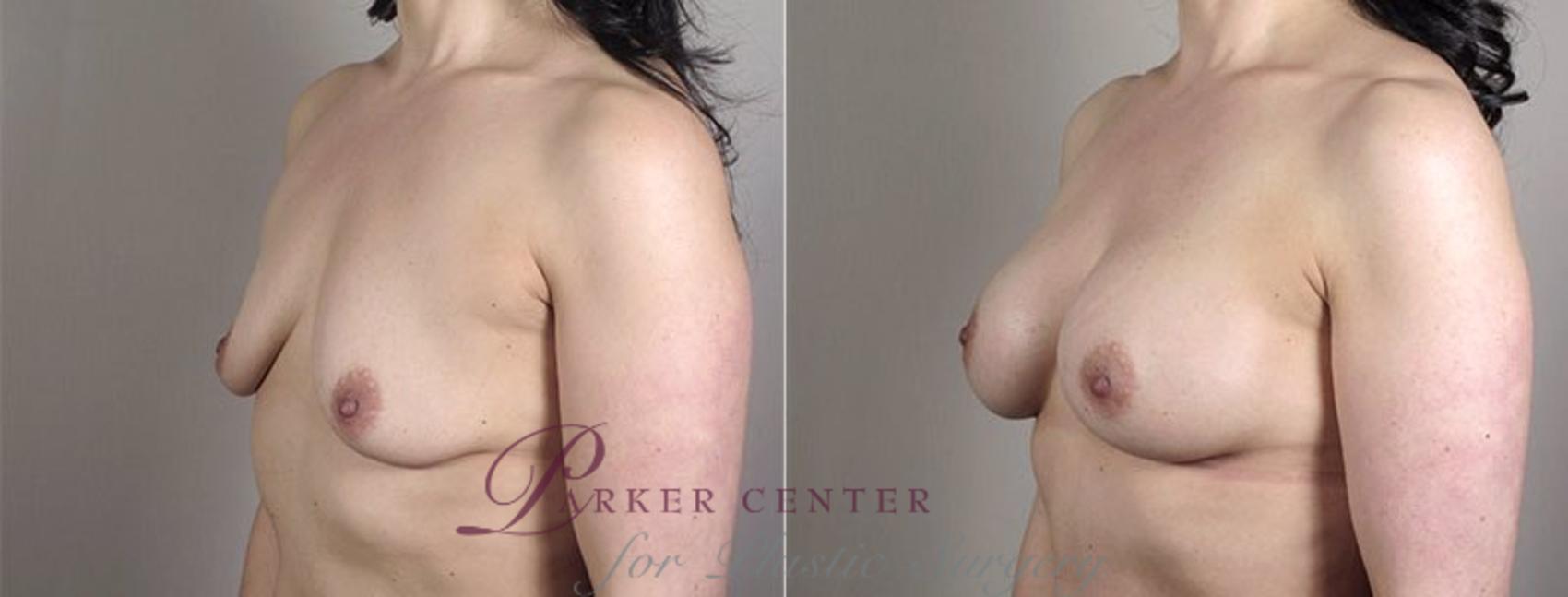 Mommy Makeover Case 407 Before & After View #2 | Paramus, NJ | Parker Center for Plastic Surgery