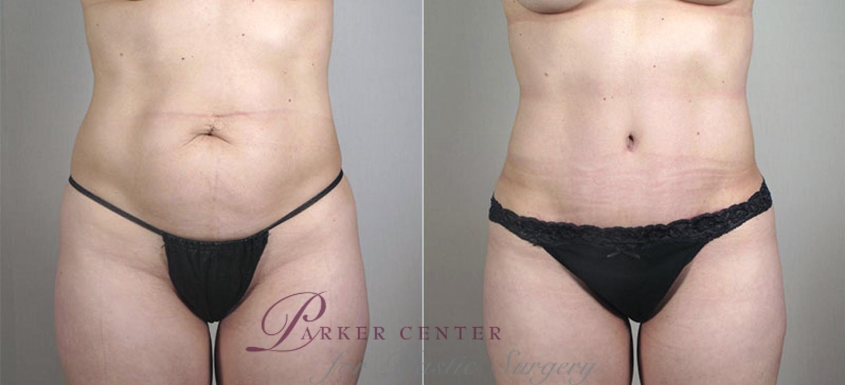 Mommy Makeover Case 407 Before & After View #3 | Paramus, NJ | Parker Center for Plastic Surgery