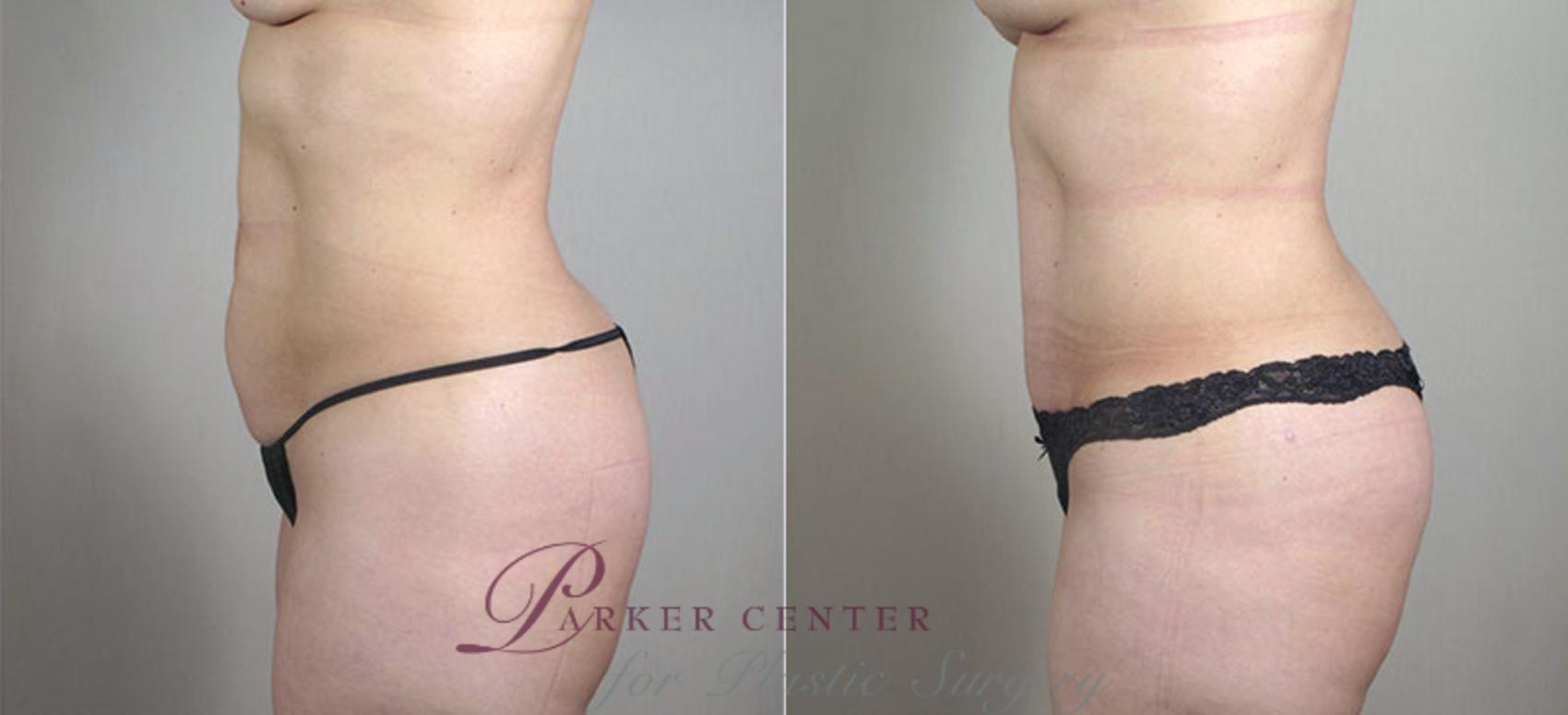 Mommy Makeover Case 407 Before & After View #4 | Paramus, NJ | Parker Center for Plastic Surgery