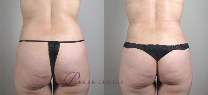 Mommy Makeover Case 407 Before & After View #5 | Paramus, NJ | Parker Center for Plastic Surgery