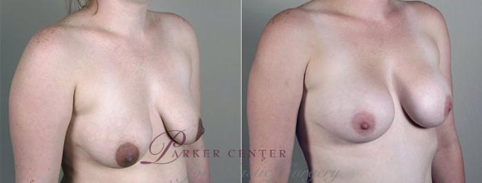 Mommy Makeover Case 408 Before & After View #2 | Paramus, NJ | Parker Center for Plastic Surgery
