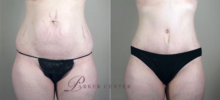 Mommy Makeover Case 408 Before & After View #3 | Paramus, NJ | Parker Center for Plastic Surgery