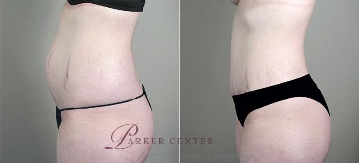 Mommy Makeover Case 408 Before & After View #4 | Paramus, NJ | Parker Center for Plastic Surgery