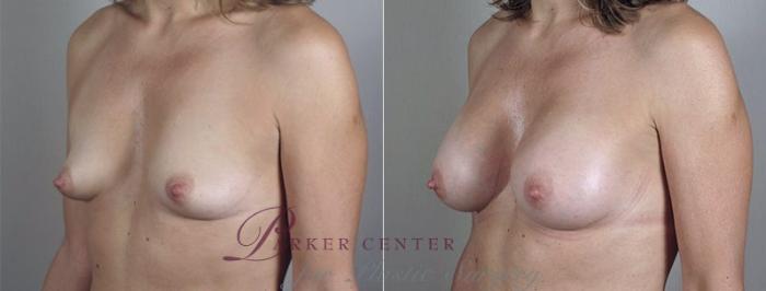 Mommy Makeover Case 426 Before & After View #2 | Paramus, NJ | Parker Center for Plastic Surgery