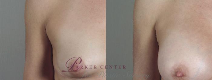 Mommy Makeover Case 426 Before & After View #3 | Paramus, NJ | Parker Center for Plastic Surgery