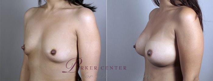 Mommy Makeover Case 437 Before & After View #2 | Paramus, NJ | Parker Center for Plastic Surgery