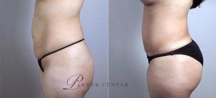 Mommy Makeover Case 437 Before & After View #4 | Paramus, NJ | Parker Center for Plastic Surgery