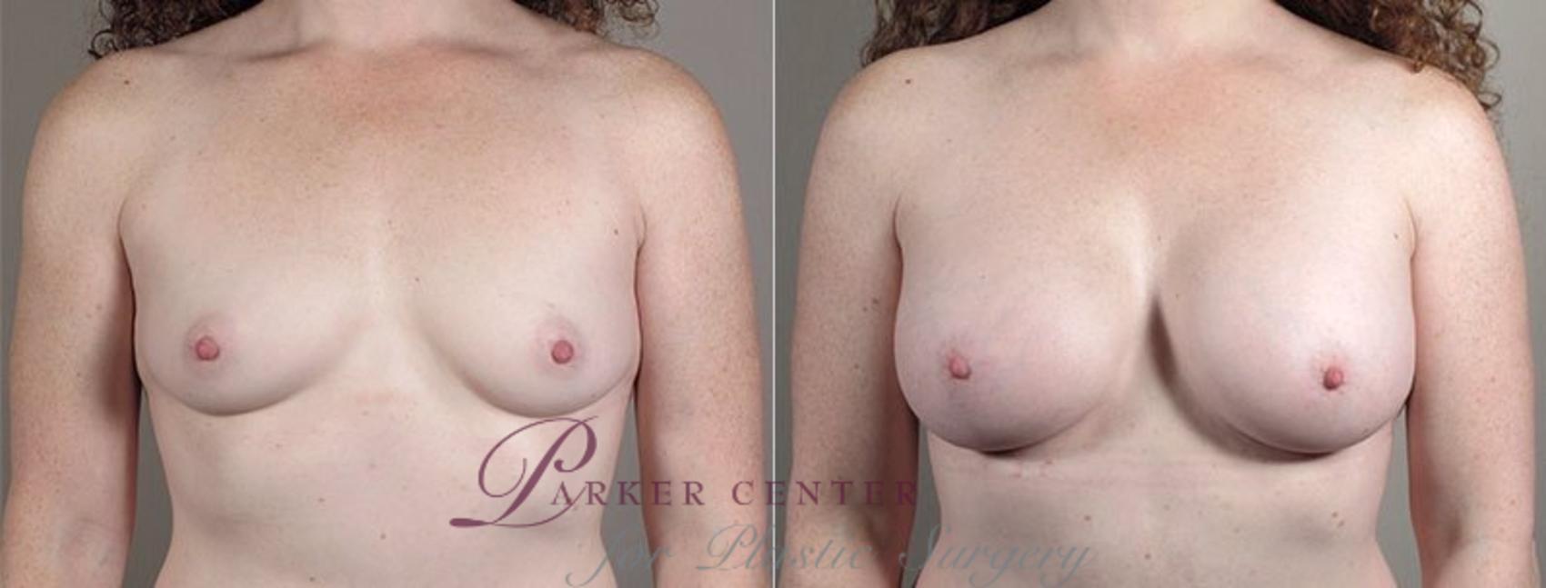 Mommy Makeover Case 440 Before & After View #1 | Paramus, NJ | Parker Center for Plastic Surgery