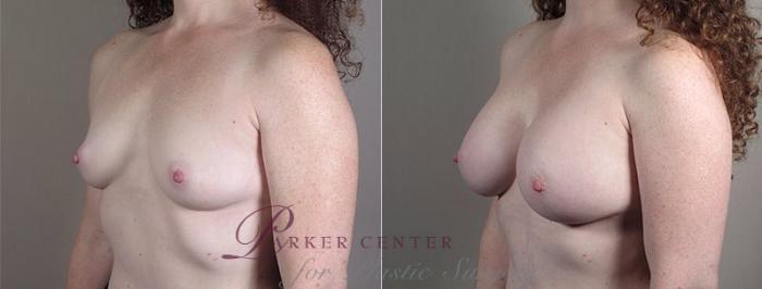 Mommy Makeover Case 440 Before & After View #2 | Paramus, NJ | Parker Center for Plastic Surgery