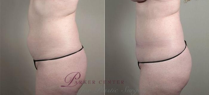 Mommy Makeover Case 440 Before & After View #4 | Paramus, NJ | Parker Center for Plastic Surgery