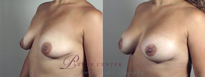 Mommy Makeover Case 443 Before & After View #4 | Paramus, NJ | Parker Center for Plastic Surgery