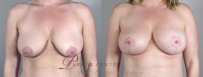 Mommy Makeover Case 461 Before & After View #1 | Paramus, NJ | Parker Center for Plastic Surgery