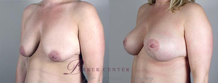 Mommy Makeover Case 461 Before & After View #2 | Paramus, NJ | Parker Center for Plastic Surgery