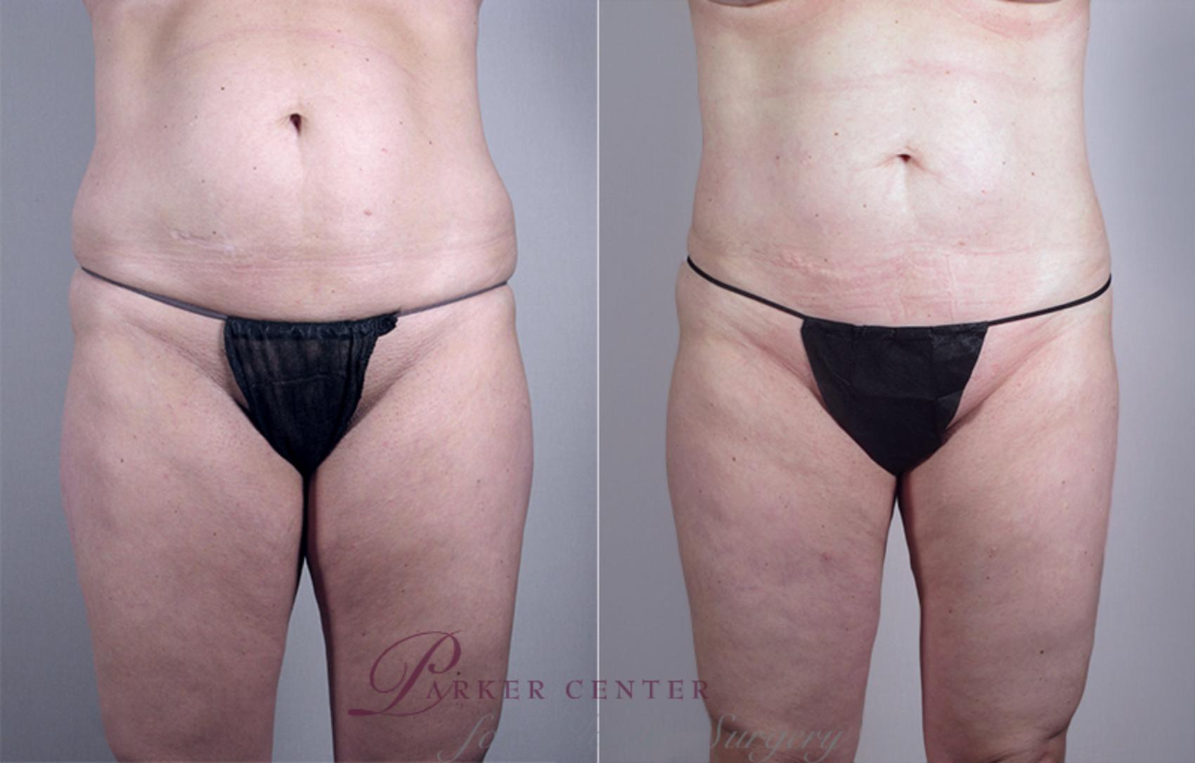 Mommy Makeover Case 461 Before & After View #3 | Paramus, NJ | Parker Center for Plastic Surgery