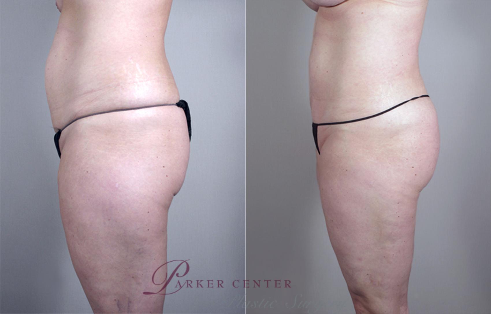 Mommy Makeover Case 461 Before & After View #4 | Paramus, NJ | Parker Center for Plastic Surgery
