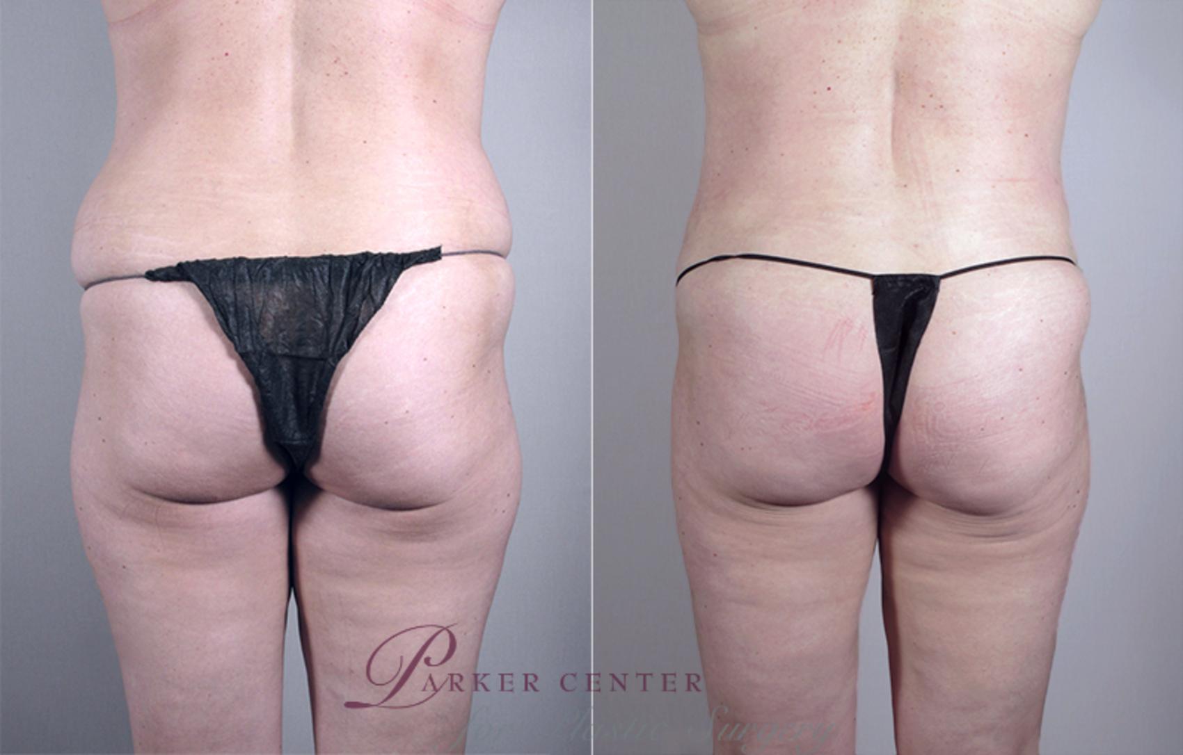 Mommy Makeover Case 461 Before & After View #5 | Paramus, NJ | Parker Center for Plastic Surgery