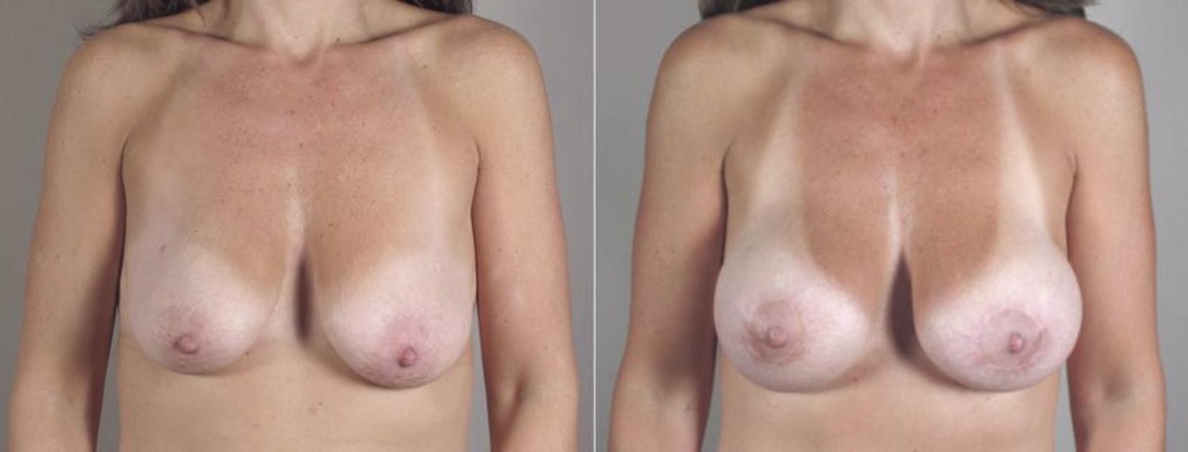 Breast Lift with Implants Case 471 Before & After View #1 | Paramus, NJ | Parker Center for Plastic Surgery