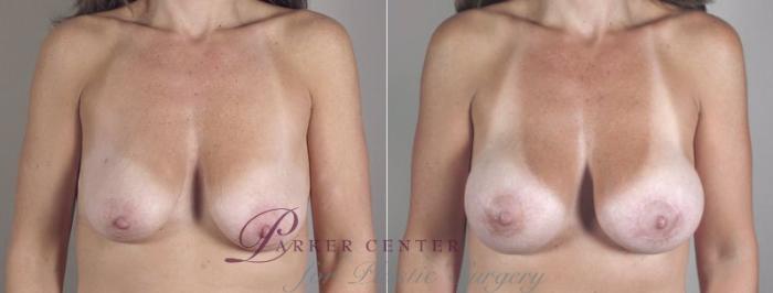 Breast Lift with Implants Case 471 Before & After View #1 | Paramus, NJ | Parker Center for Plastic Surgery