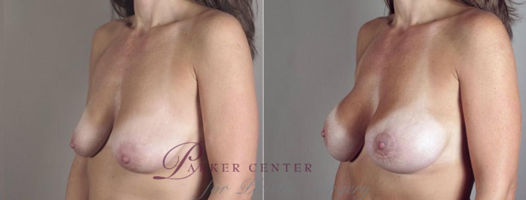 Breast Lift with Implants Case 471 Before & After View #2 | Paramus, NJ | Parker Center for Plastic Surgery