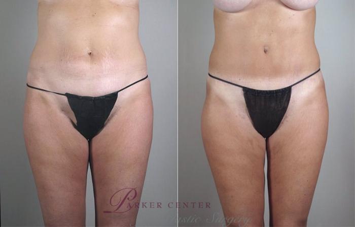 Mommy Makeover Case 471 Before & After View #3 | Paramus, NJ | Parker Center for Plastic Surgery