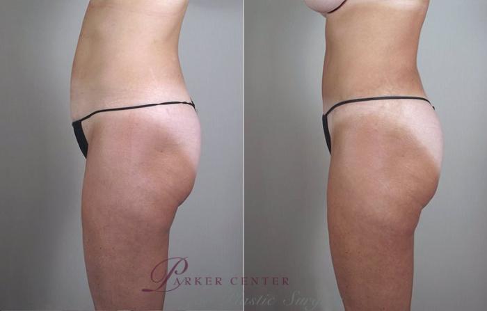 Mommy Makeover Case 471 Before & After View #4 | Paramus, NJ | Parker Center for Plastic Surgery