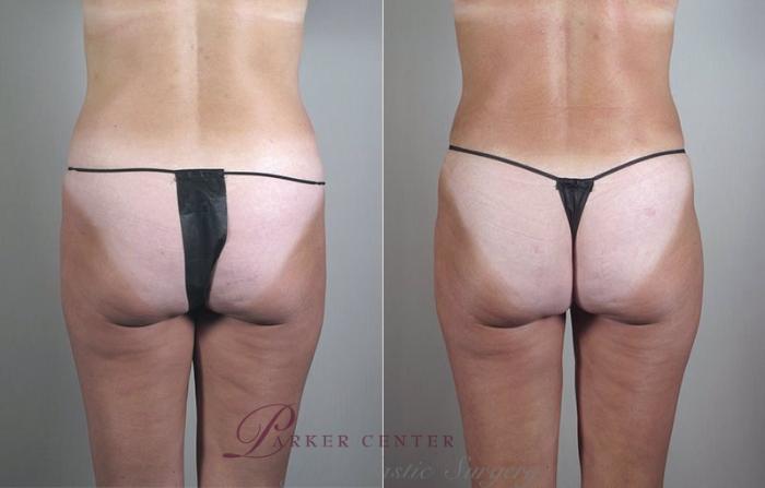 Mommy Makeover Case 471 Before & After View #5 | Paramus, NJ | Parker Center for Plastic Surgery