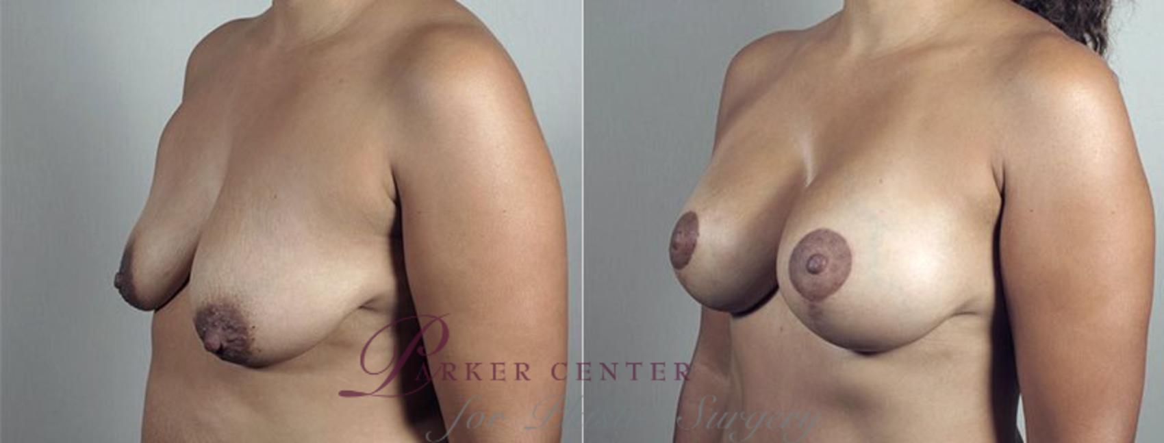 Mommy Makeover Case 496 Before & After View #2 | Paramus, NJ | Parker Center for Plastic Surgery