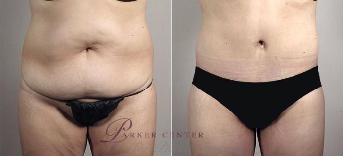 Upper Arm Rejuvenation Case 558 Before & After View #1 | Paramus, NJ | Parker Center for Plastic Surgery