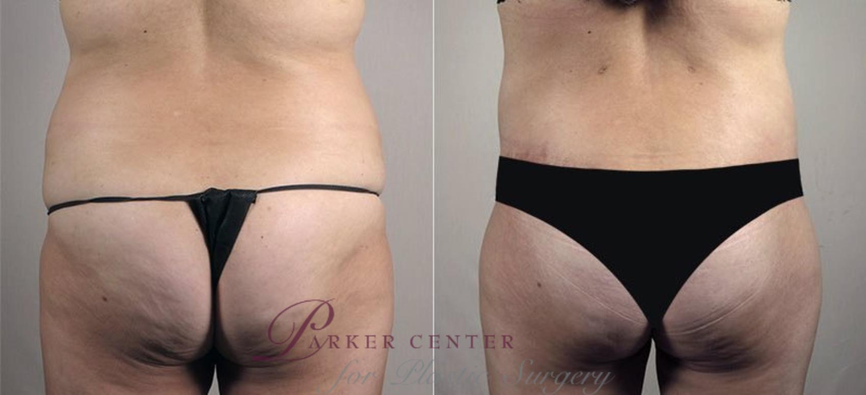 Mommy Makeover Case 558 Before & After View #4 | Paramus, NJ | Parker Center for Plastic Surgery