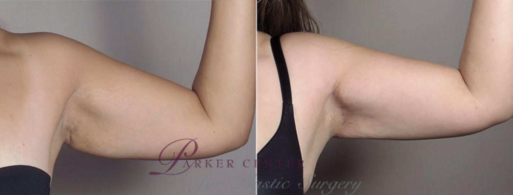 Mommy Makeover Case 558 Before & After View #6 | Paramus, NJ | Parker Center for Plastic Surgery