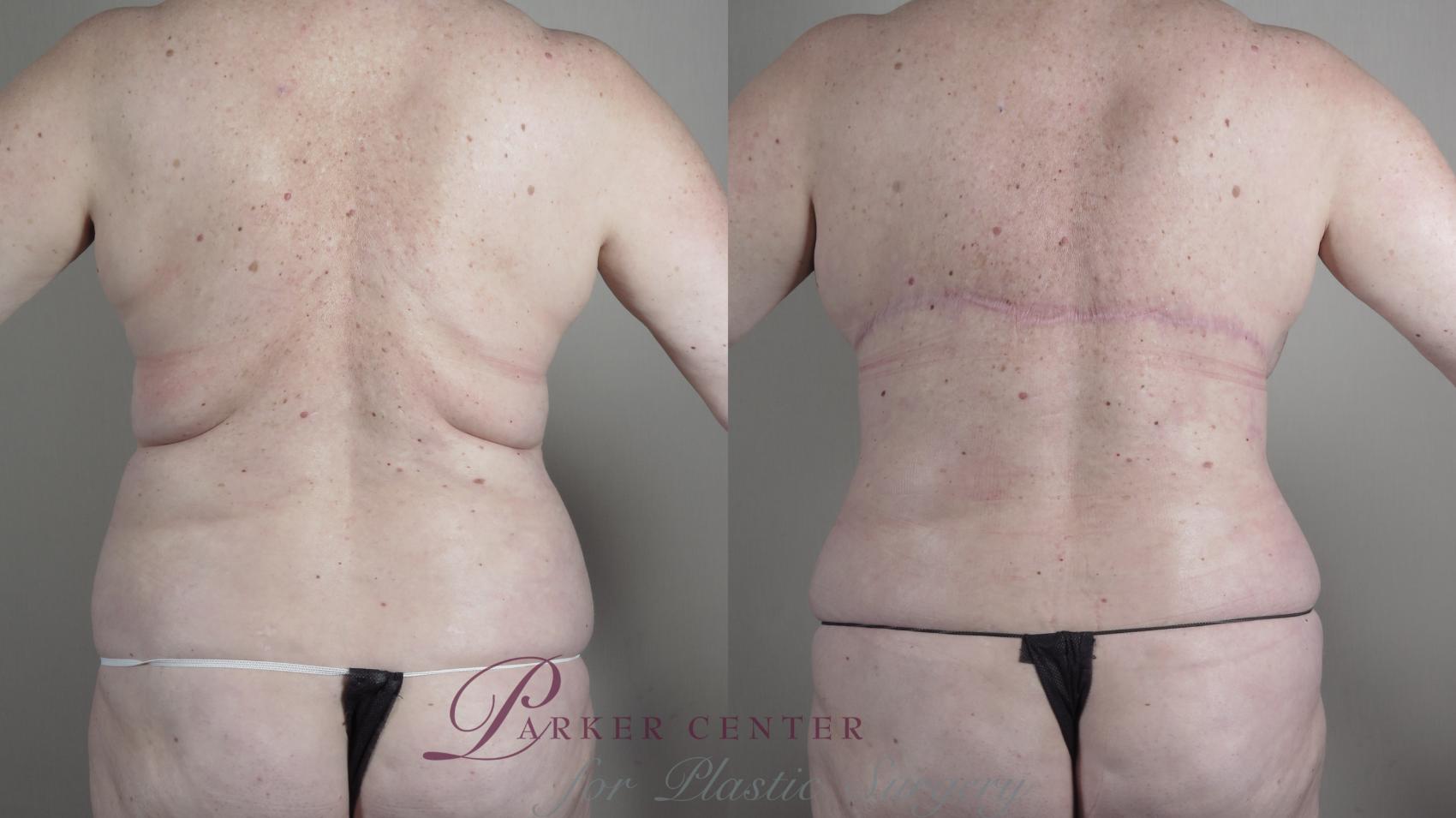 Tummy Tuck Case 987 Before & After Back w/o bra | Paramus, NJ | Parker Center for Plastic Surgery