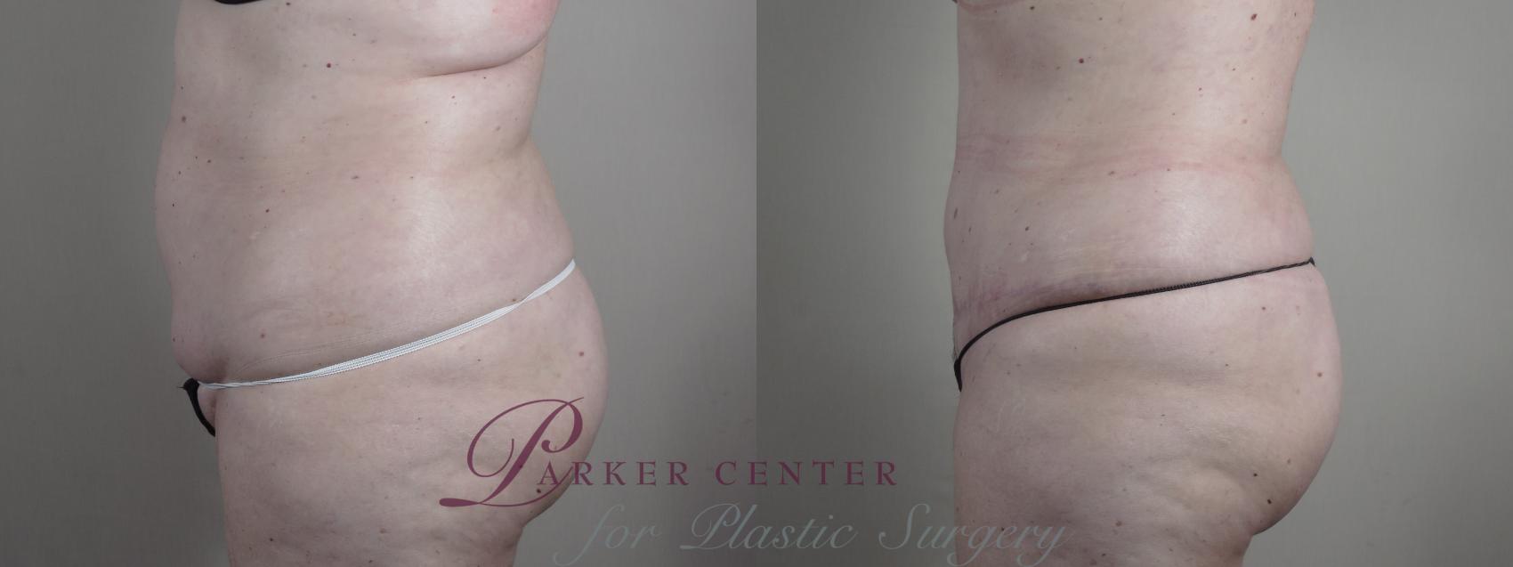Tummy Tuck Case 987 Before & After Right Side | Paramus, NJ | Parker Center for Plastic Surgery