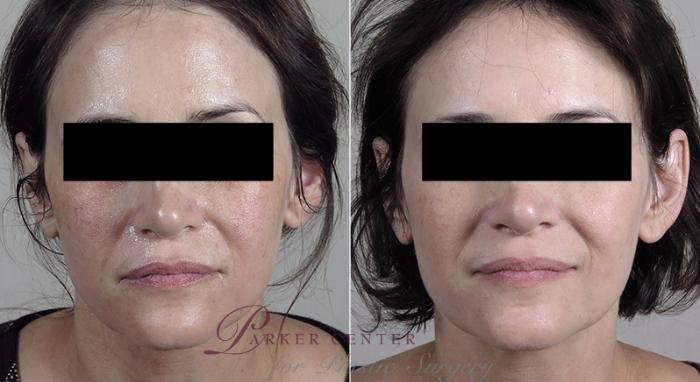 Morpheus8 Skin Tightening Case 341 Before & After View #1 | Paramus, New Jersey | Parker Center for Plastic Surgery