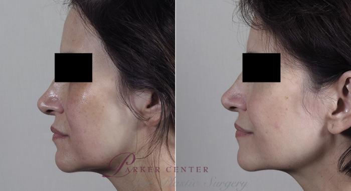 Morpheus8 Skin Tightening Case 341 Before & After View #2 | Paramus, New Jersey | Parker Center for Plastic Surgery