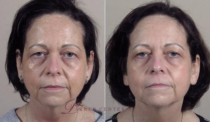 Morpheus8 Skin Tightening Case 342 Before & After View #1 | Paramus, New Jersey | Parker Center for Plastic Surgery