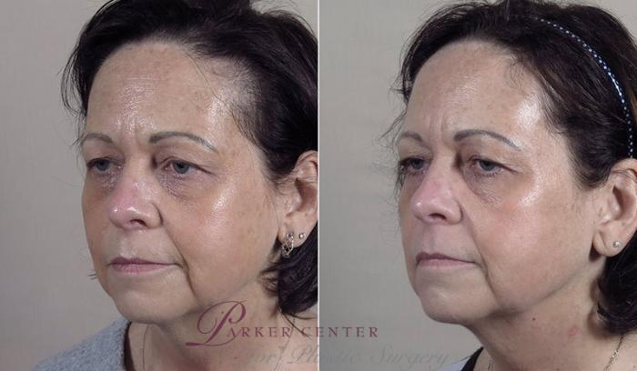 Morpheus8 Skin Tightening Case 342 Before & After View #2 | Paramus, New Jersey | Parker Center for Plastic Surgery