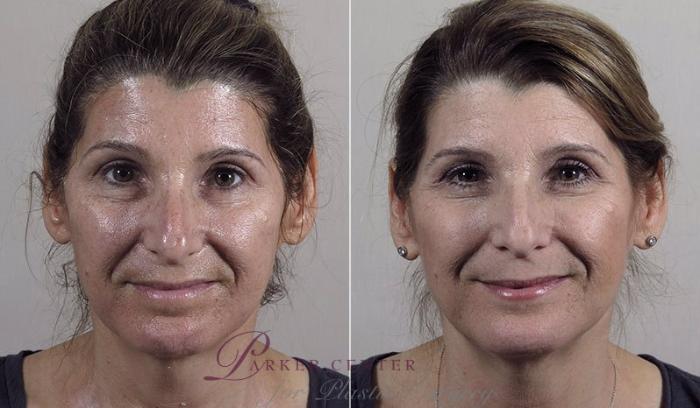 Morpheus8 Skin Tightening Case 343 Before & After View #1 | Paramus, New Jersey | Parker Center for Plastic Surgery