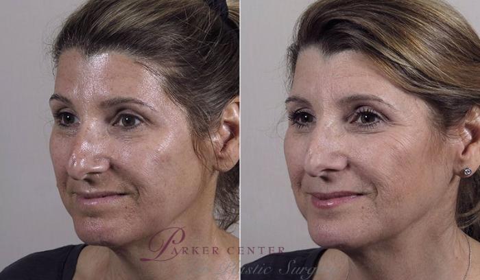 Morpheus8 Skin Tightening Case 343 Before & After View #2 | Paramus, New Jersey | Parker Center for Plastic Surgery