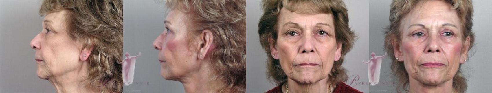 Eyelid Lift Case 1116 Before & After Front | Paramus, NJ | Parker Center for Plastic Surgery