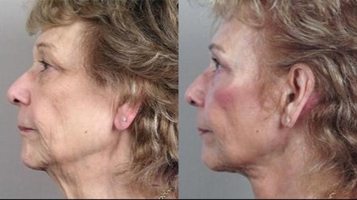 Neck Contouring Case 1116 Before & After Side view | Paramus, New Jersey | Parker Center for Plastic Surgery