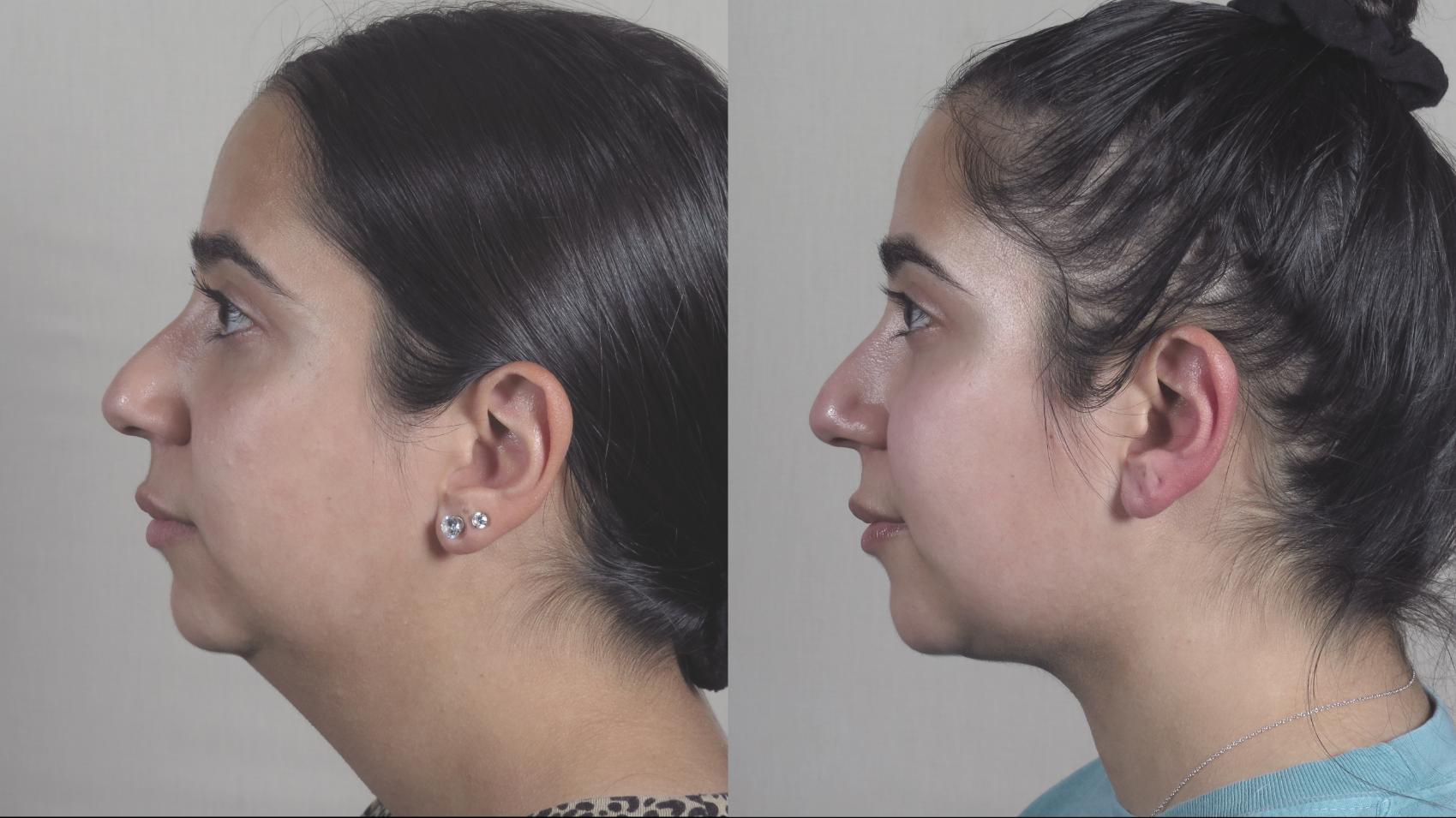 Neck Contouring Case 1215 Before & After Left Side | Paramus, New Jersey | Parker Center for Plastic Surgery