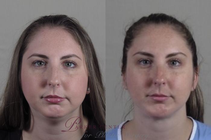 Neck Contouring Case 1251 Before & After Front | Paramus, NJ | Parker Center for Plastic Surgery