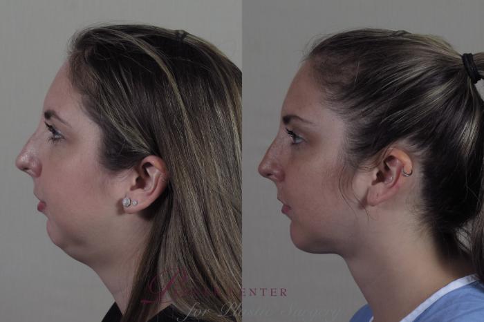 Neck Contouring Case 1251 Before & After Left Side | Paramus, NJ | Parker Center for Plastic Surgery