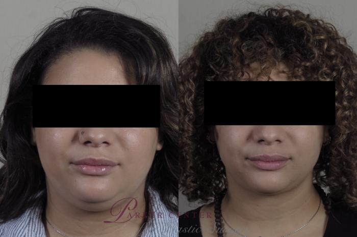 Neck Contouring Case 1305 Before & After Front | Paramus, NJ | Parker Center for Plastic Surgery