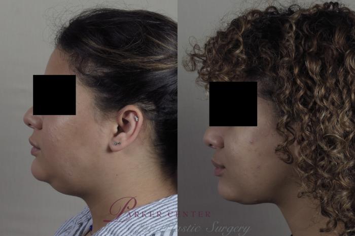 Neck Contouring Case 1305 Before & After Left Side | Paramus, NJ | Parker Center for Plastic Surgery