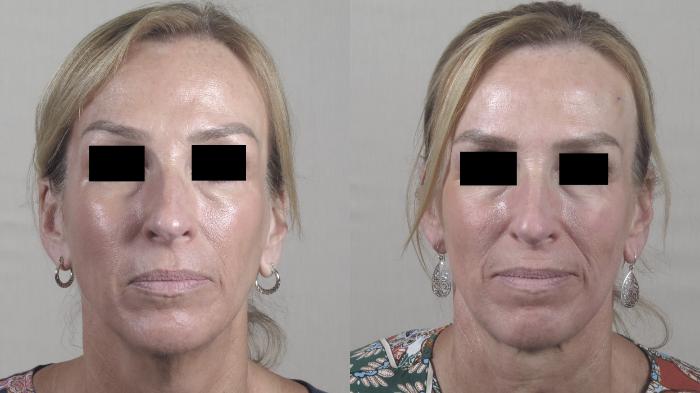 Neck Contouring Case 1306 Before & After front view | Paramus, New Jersey | Parker Center for Plastic Surgery